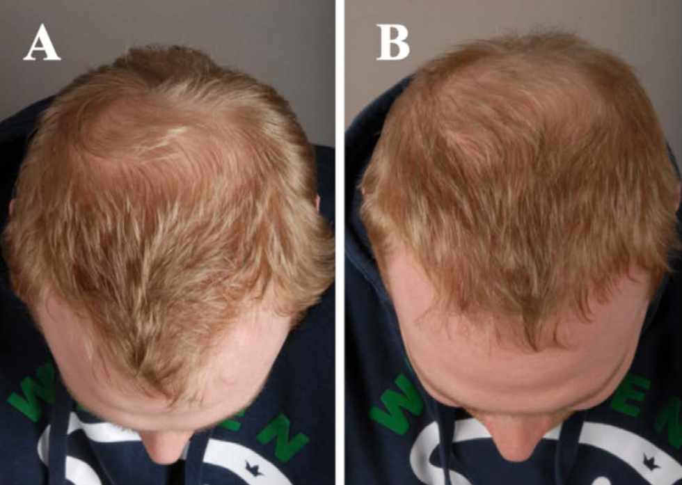 Before and after comparison of hair density on a person's scalp.